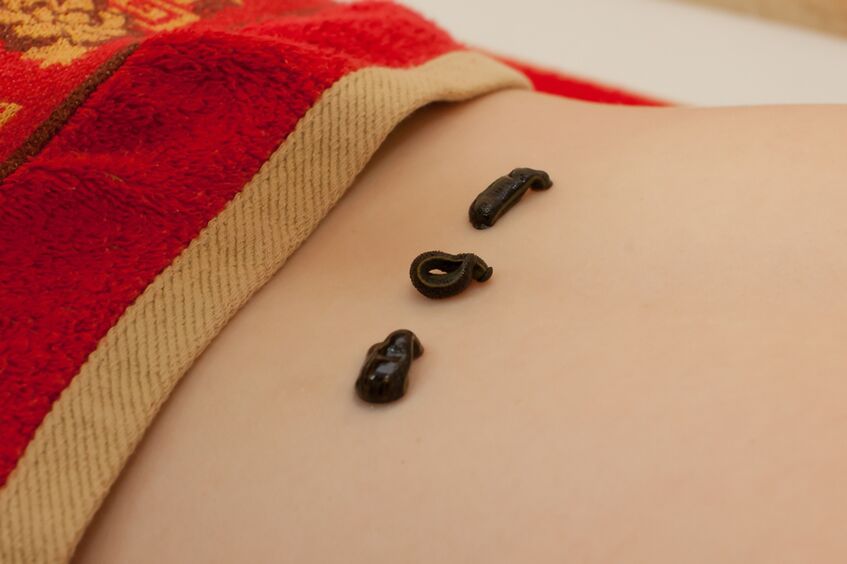 pijavice na spodní části zad s osteochondrózou