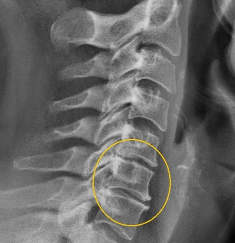 Cervikální osteochondrosis